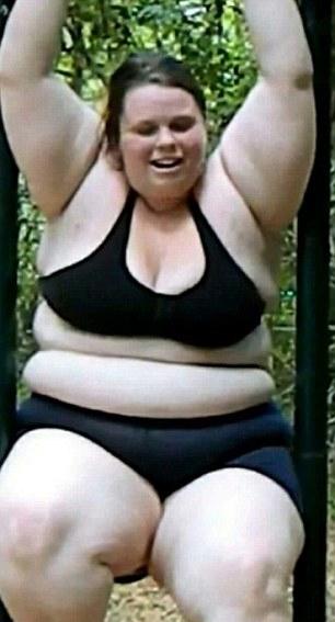 女子减重87公斤后皮肤重松弛下垂 丑陋不堪
