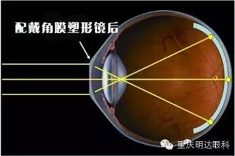 【爱眼日科普】关于角膜塑形镜你了解多少?
