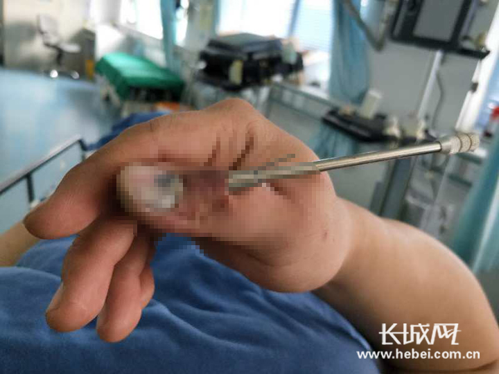 患者拇指被鱼镖射中 唐山市第二医院医生妙手取出