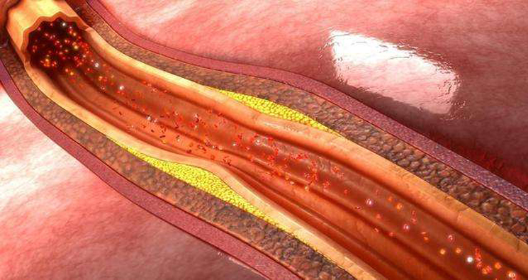 颈动脉斑块状况——血管健康与否的晴雨表